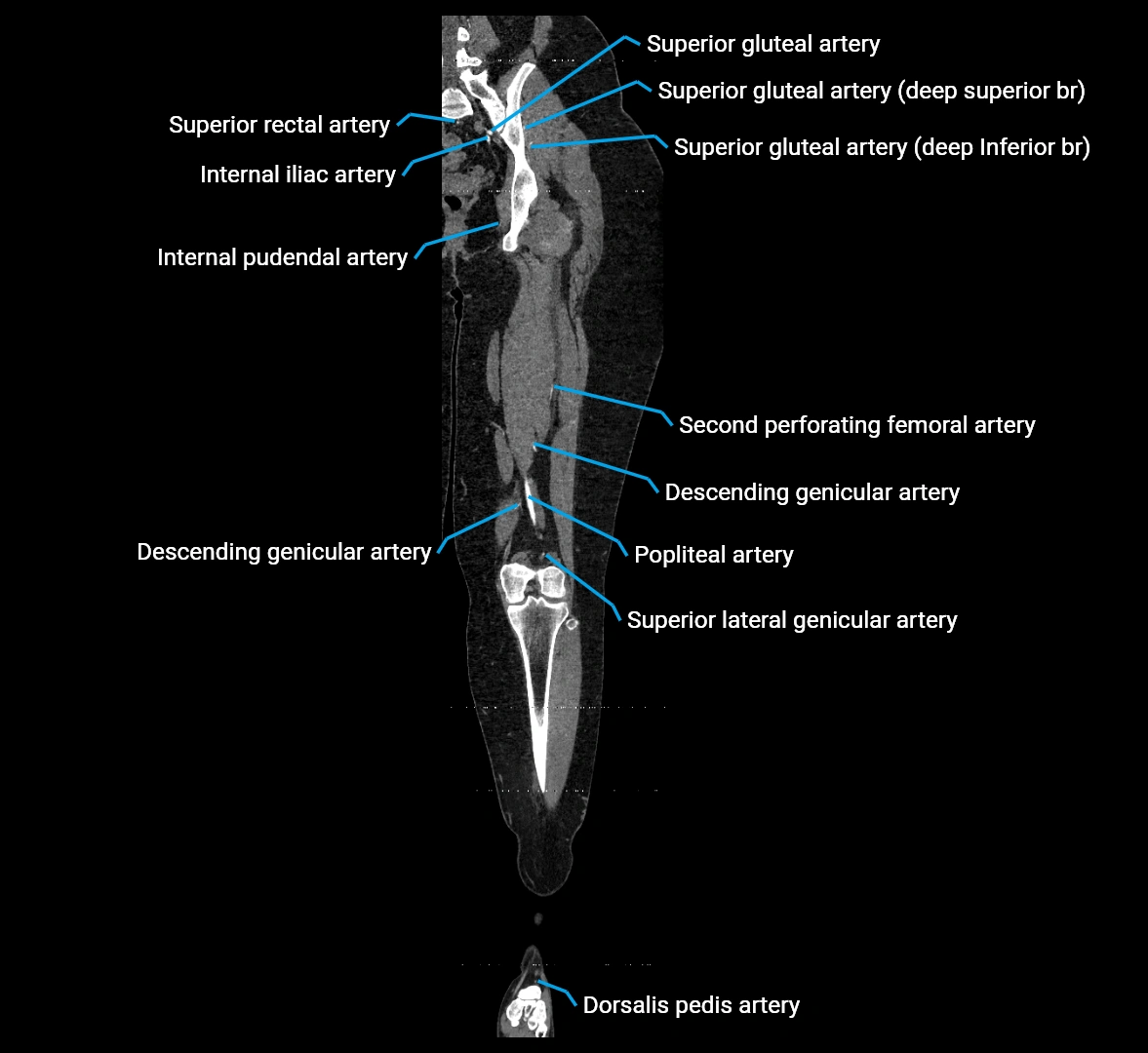 CTA lower limb coronal cross sectional anatomy labelled image _50 (2).webp